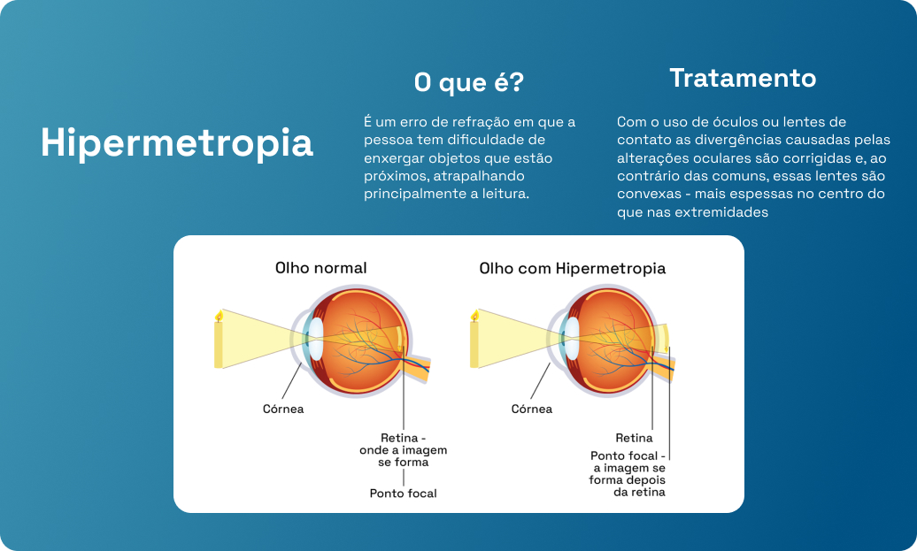 Hipermetropia